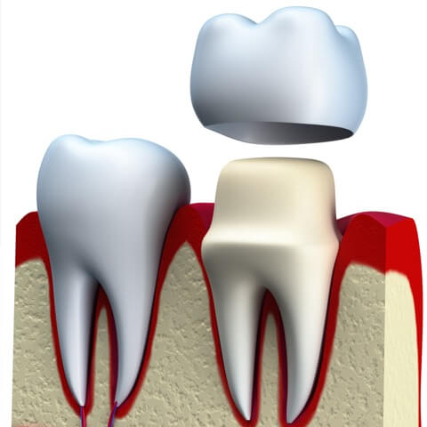a graphic displays how a crown fits over a tooth