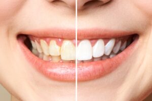 results from professional teeth whitening