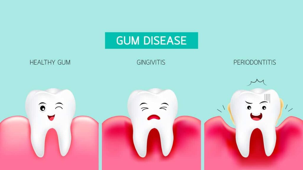 Gum Disease Diagram