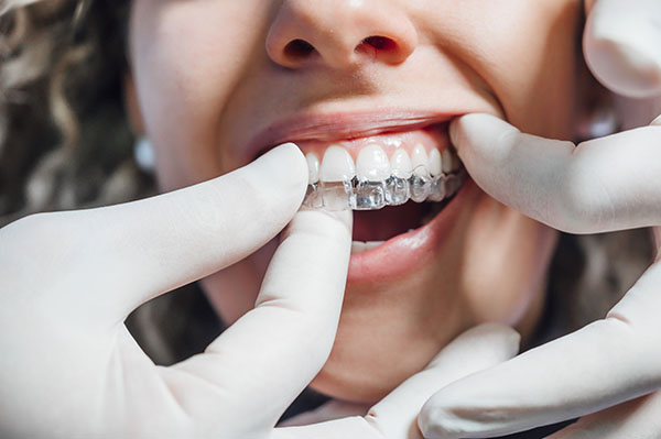 A dentist helps a patient fit a set of clear dental aligners to their teeth.
