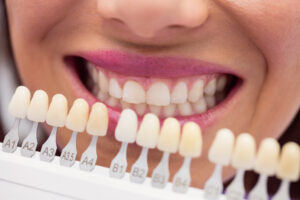 Patient considers porcelain veneers vs. composite veneers as a dentist reviews teeth color options with the patient.