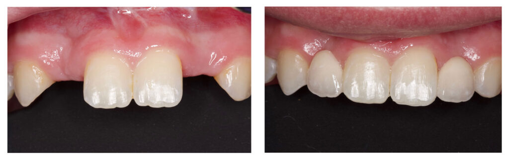 Patients with missing teeth like those on the left here can experience a full smile like that on the right through the teen cosmetic dentistry services at Cedarwood Dentistry.